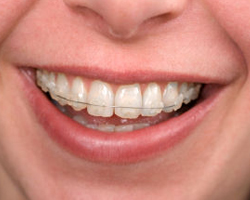 Ceramic Braces