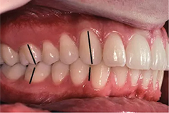 Class 1 Malocclusion