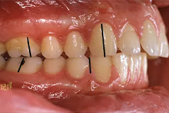 Class 2 Malocclusion