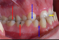 Class 3 Malocclusion