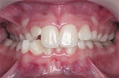 crossbite