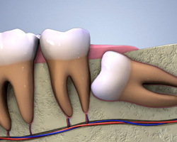 Impacted Teeth