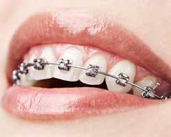 Stainless Steel Braces