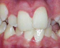 Teeth Crowning